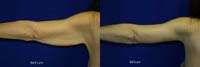 Arm Lift Before and After Photos